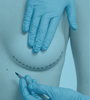 Mastoplastia de Aumento
